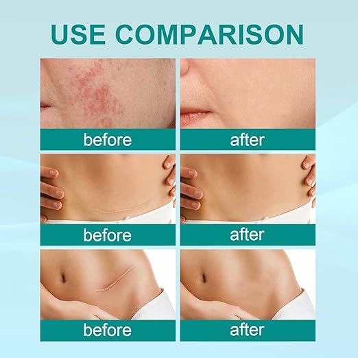 South Moon Medical Scar Removal Spray