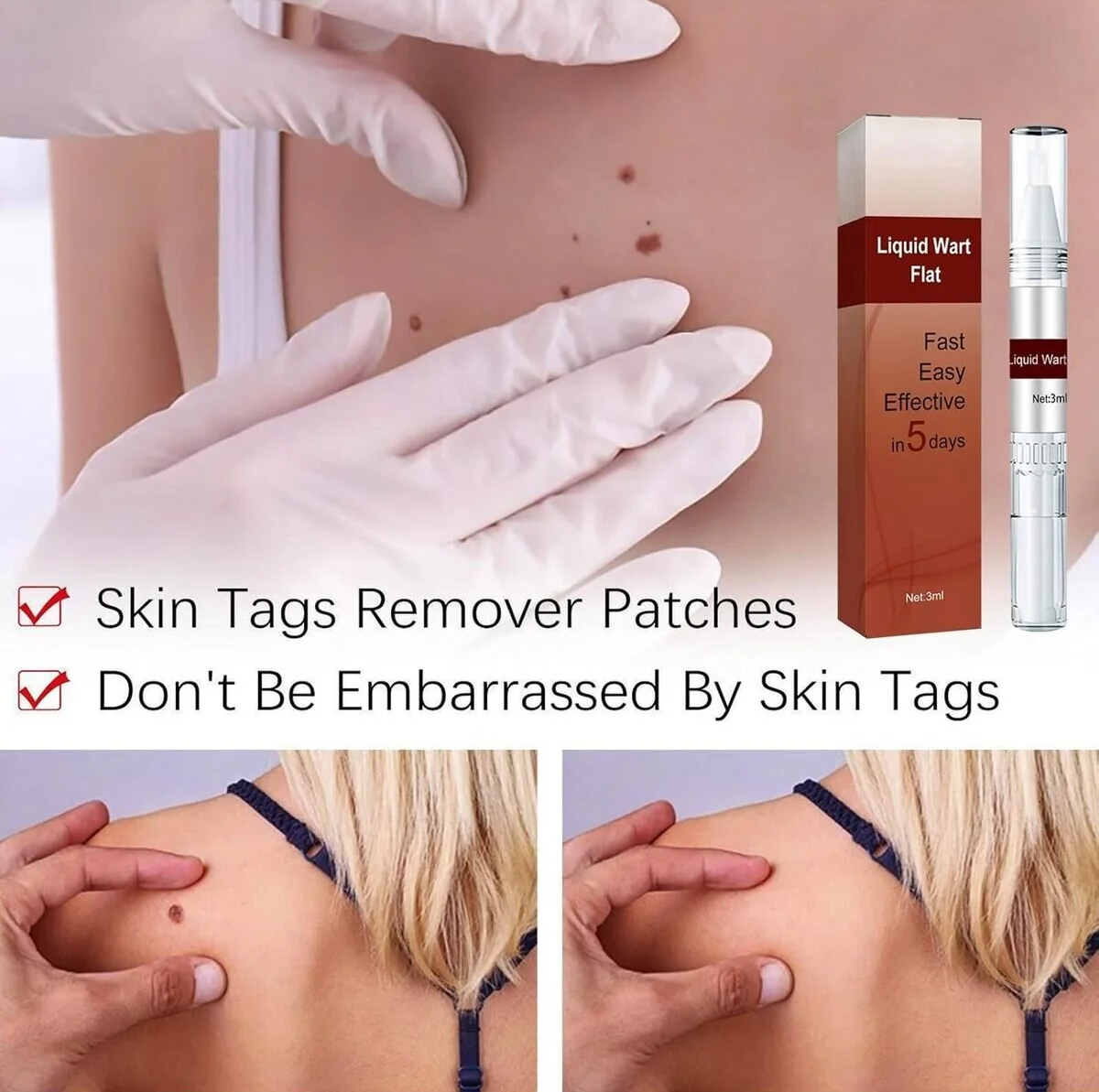 Promotional collage for a liquid wart removal patch product. It shows gloved hands touching skin with visible skin tags, two inset views of a woman's shoulder with skin tags, and the product packaging plus a small applicator bottle on the right.
