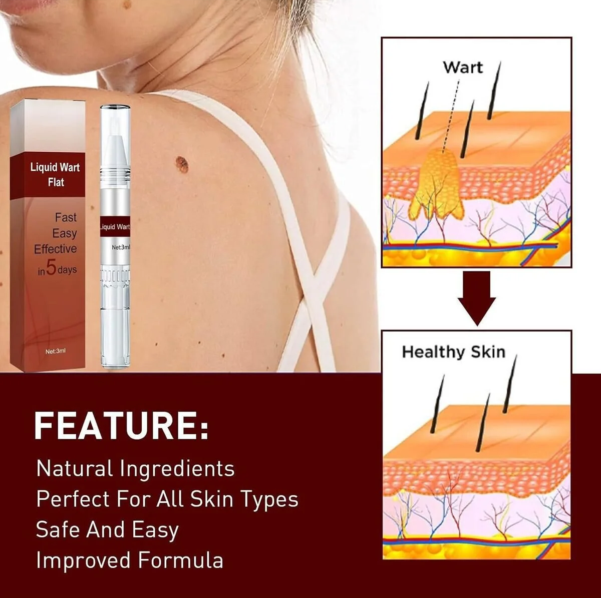 Liquid wart flat treatment shown with a model's shoulder and neck, product box and pen applicator, and skin diagram illustrations showing wart removal and healthy skin.