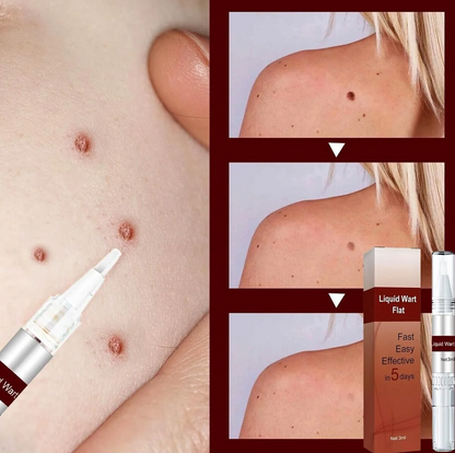 A collage showing a liquid wart removal treatment: a close-up of skin with several brown warts, a dropper applicator touching the skin, three before-and-after shoulder wart comparison panels, and the product box and bottle labeled 'Liquid Wart Flat'.