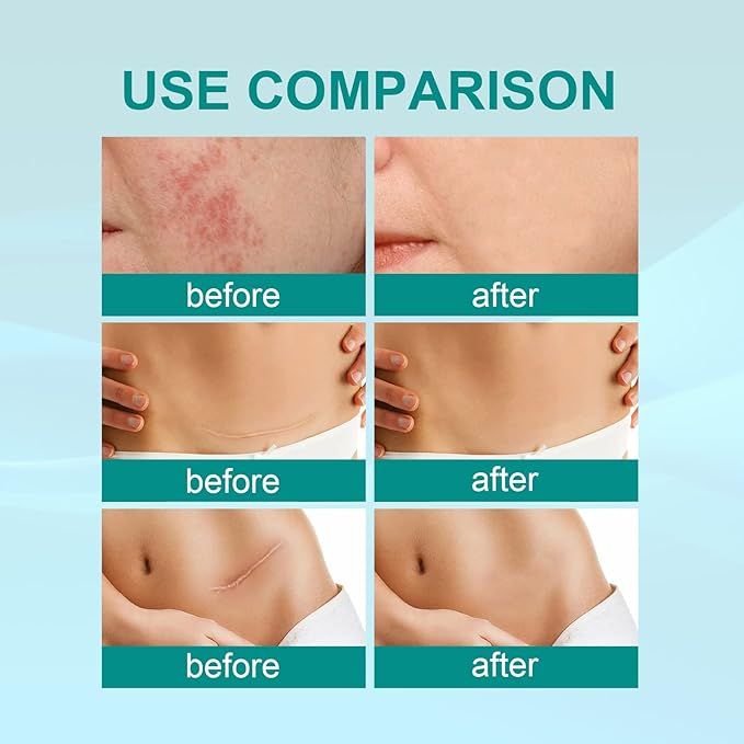 South Moon Medical Scar Removal Spray
