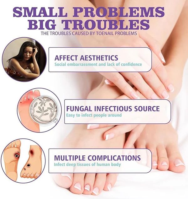 JAYSUING Nail Fungus Spray